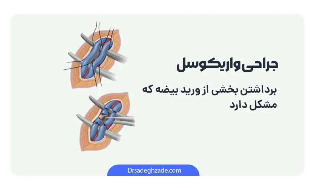 اینفوگرافی جراحی واریکوسل