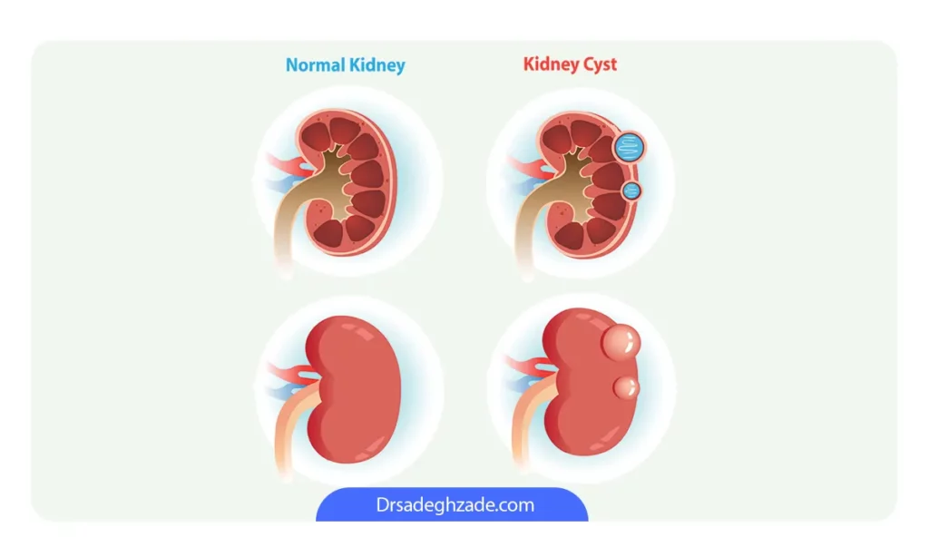 عکس کلیه سالم و کیست کلیه