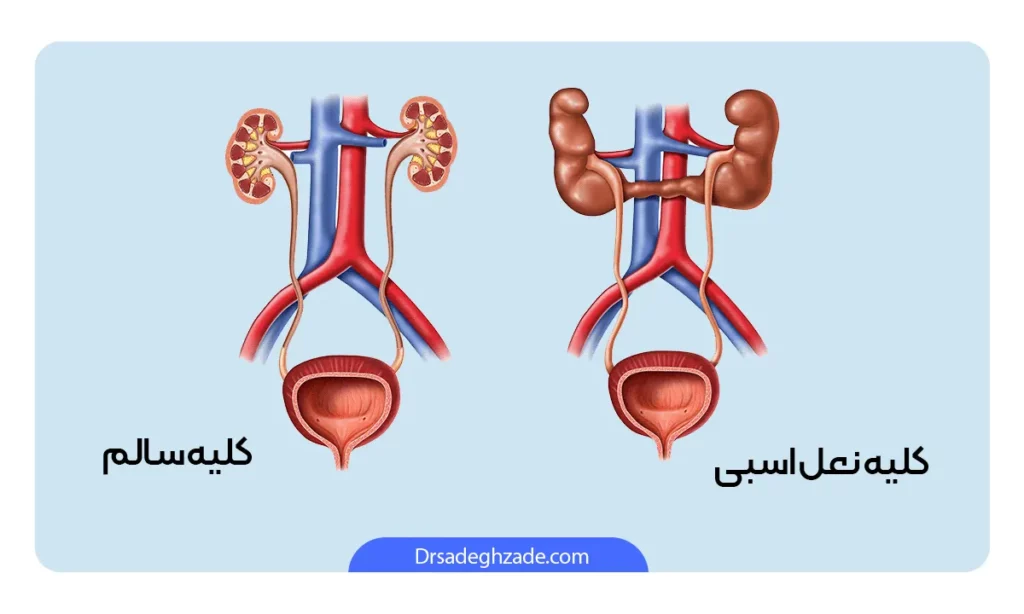 تفاوت کلیه سالم و نعل ابی اینفوگرافی